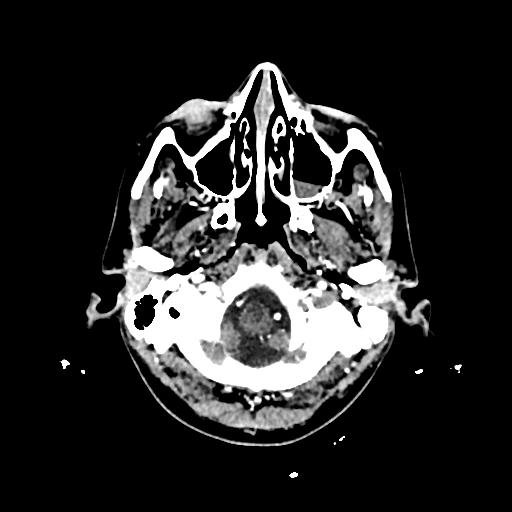 Cerebral venous thrombosis with venous hemorrhagic infarct (Radiopaedia 90354-107660 Axial with contrast 21).jpg