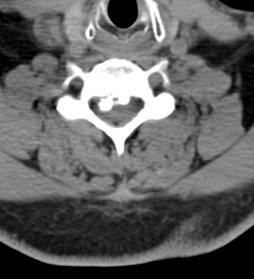 Cervical canal stenosis due to ossification of the posterior longitudinal ligament (Radiopaedia 47260-51823 Axial non-contrast 42).png