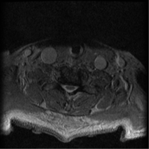 File:Cervical canal stenosis with cord compression (Radiopaedia 34114-35374 Axial Gradient Echo 21).png