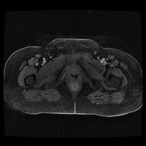 Cervical carcinoma (Radiopaedia 70924-81132 Axial T1 C+ fat sat 199).jpg