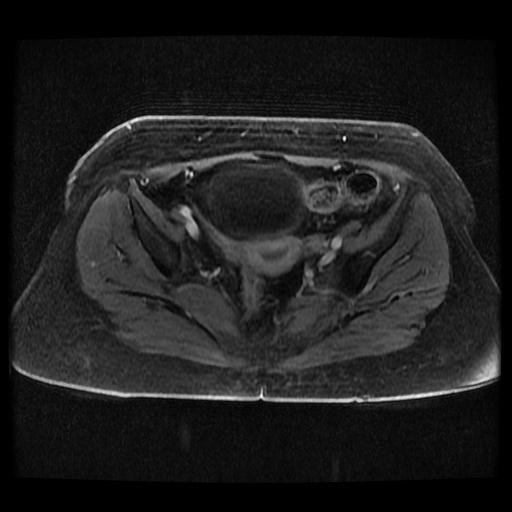 Cervical carcinoma (Radiopaedia 70924-81132 Axial T1 C+ fat sat 235).jpg