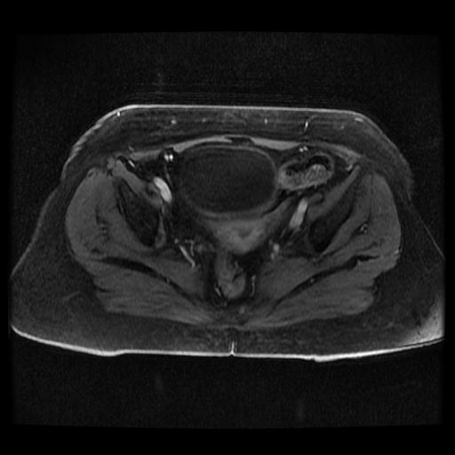 Cervical carcinoma (Radiopaedia 70924-81132 Axial T1 C+ fat sat 55).jpg