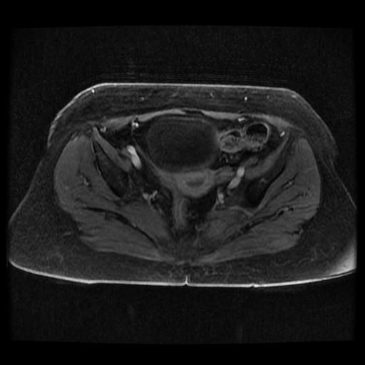 File:Cervical carcinoma (Radiopaedia 70924-81132 Axial T1 C+ fat sat 58).jpg