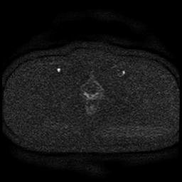 Cervical carcinoma (Radiopaedia 85405-101028 Axial DWI 61).jpg