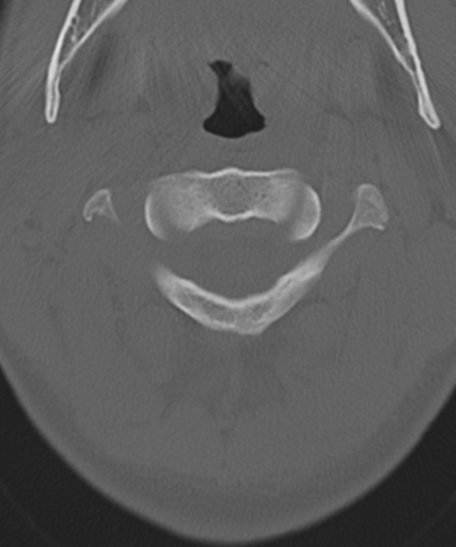 Cervical intercalary bone (Radiopaedia 35211-36748 Axial bone window 16).png