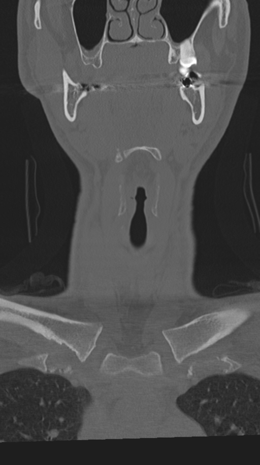 Cervical intercalary bone (Radiopaedia 35211-36748 Coronal bone window 3).png