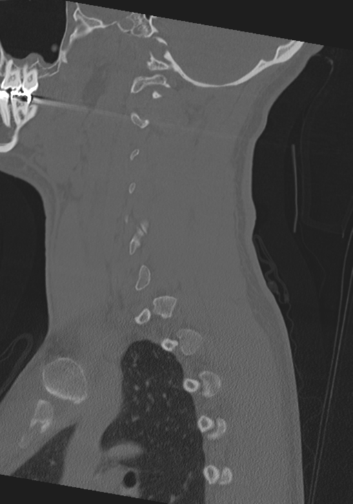 Cervical intercalary bone (Radiopaedia 35211-36748 Sagittal bone window 59).png