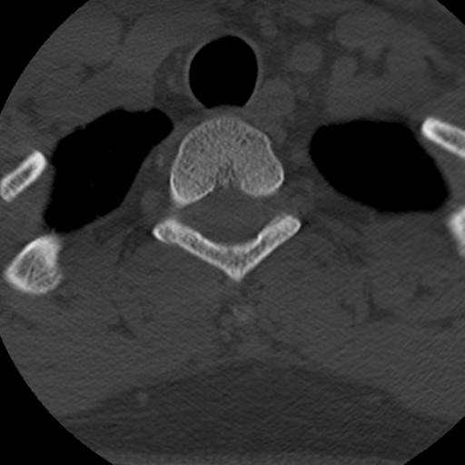 Cervical schwannoma (Radiopaedia 57979-64974 Axial bone window 46).png