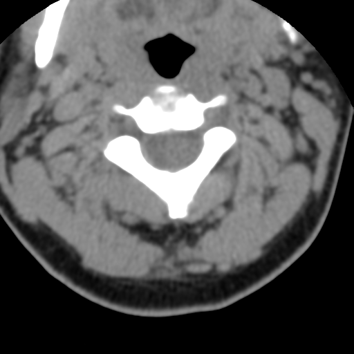 Cervical schwannoma (Radiopaedia 57979-64974 Axial non-contrast 23).png