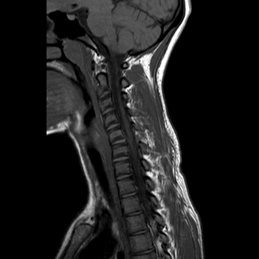 File:Cervical spine posterior ligamentous complex rupture (Radiopaedia 63486-72103 Sagittal T1 5).jpg