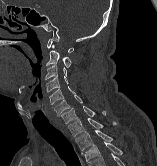 Cervical spine trauma with tear drop fracture and perched facet joint (Radiopaedia 53989-60127 Sagittal bone window 64).jpg
