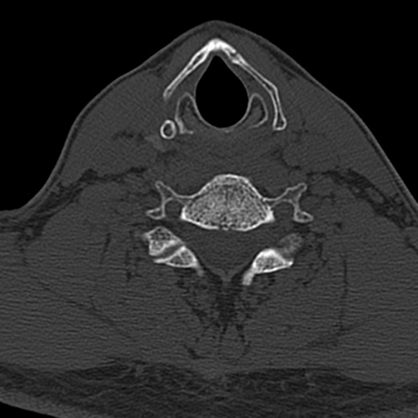 Cervical spondylodiscitis (Radiopaedia 28057-29489 Axial bone window 55).jpg