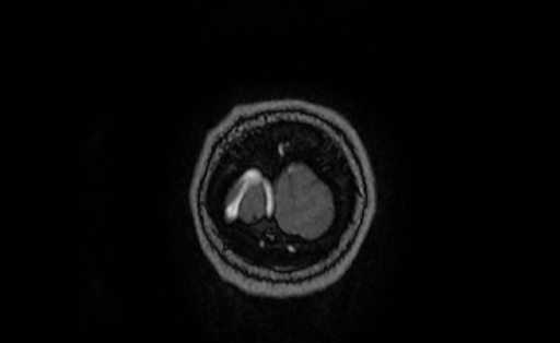 Cervical spondylodiscitis and calvarial hemangioma (Radiopaedia 64317-73103 Coronal T1 C+ 75).jpg