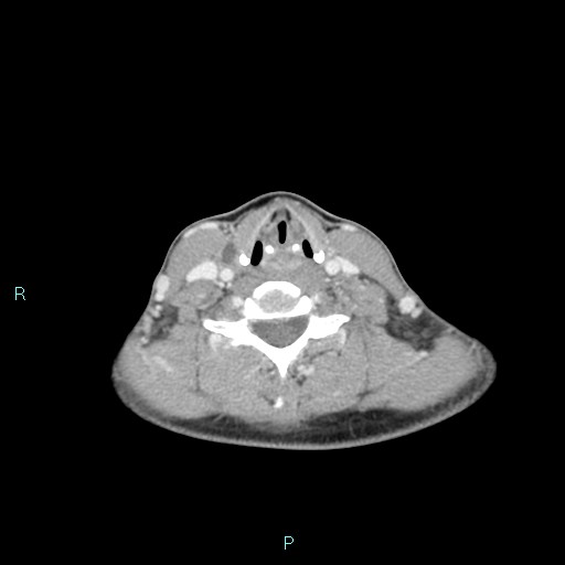 File:Cervical thymic cyst (Radiopaedia 88632-105335 C 50).jpg
