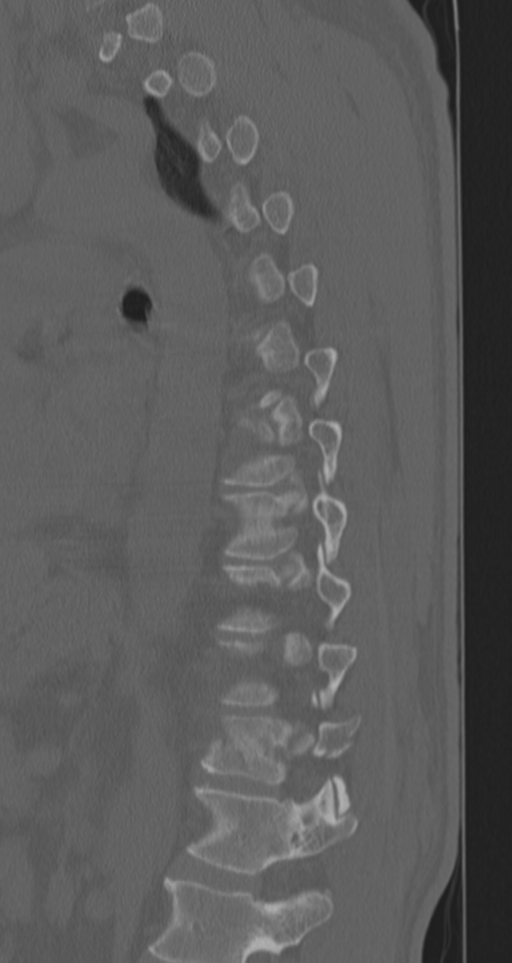 Chance fracture (Radiopaedia 33854-35020 Sagittal bone window 31).png