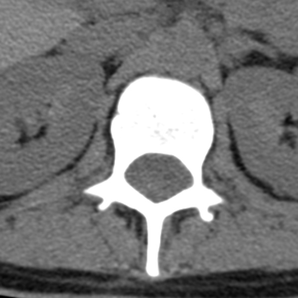 File:Chance fracture (Radiopaedia 36521-38081 Axial non-contrast 69).jpg