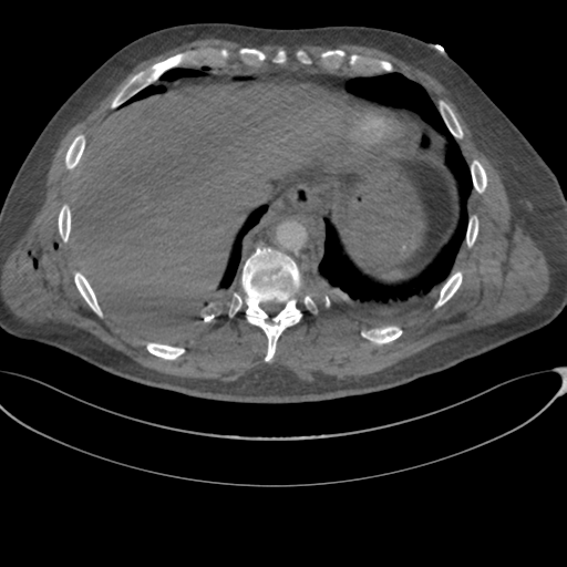 File:Chest multitrauma - aortic injury (Radiopaedia 34708-36147 A 245).png