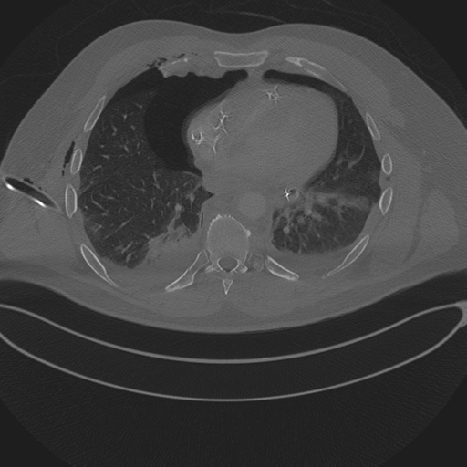 Chest multitrauma - aortic injury (Radiopaedia 34708-36147 Axial bone window 189).png