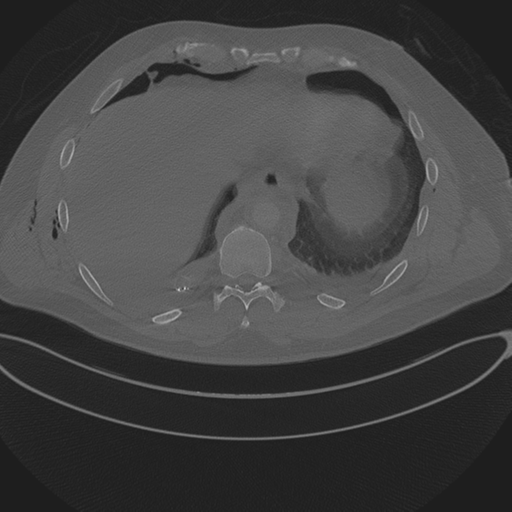 Chest multitrauma - aortic injury (Radiopaedia 34708-36147 Axial bone window 234).png