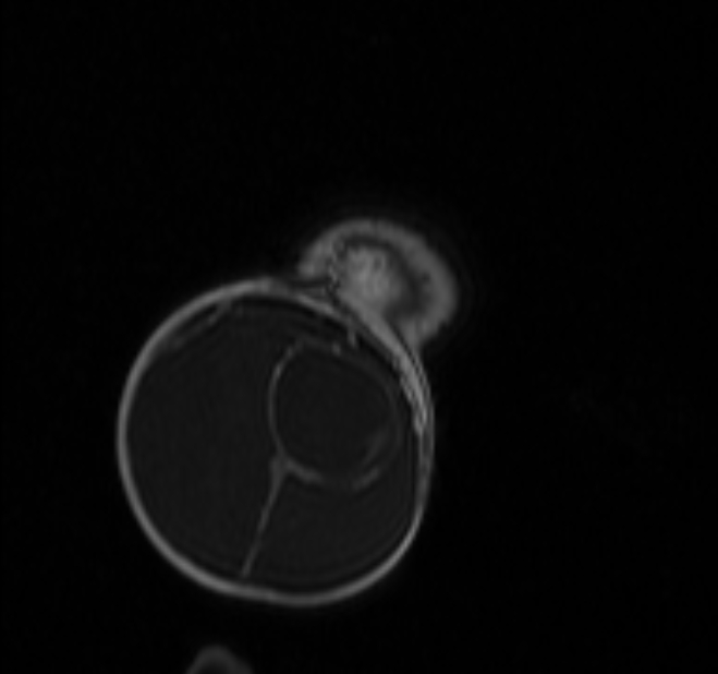 Chiari III malformation with occipital encephalocele (Radiopaedia 79446-92559 Coronal T1 C+ mpr 54).jpg