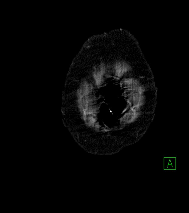 Cholangiocarcinoma with cerebral metastases (Radiopaedia 83519-98629 E 2).jpg