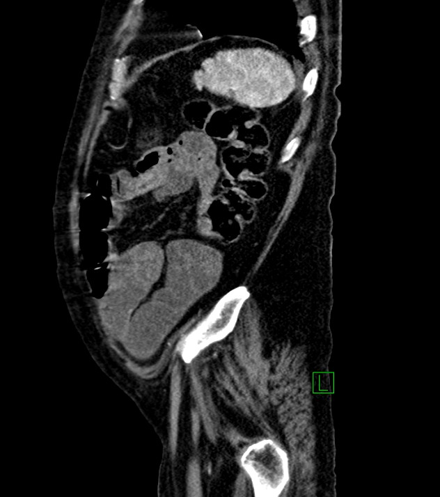 Cholangiocarcinoma with cerebral metastases (Radiopaedia 83519-98629 F 23).jpg
