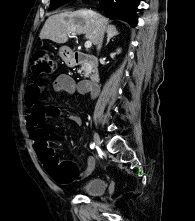 Cholangiocarcinoma with cerebral metastases (Radiopaedia 83519-98629 F 73).jpg