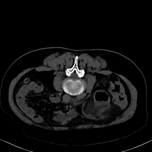 File:Cholecystitis - obstructive choledocholitiasis (CT intravenous cholangiography) (Radiopaedia 43966-47479 Axial 68).png