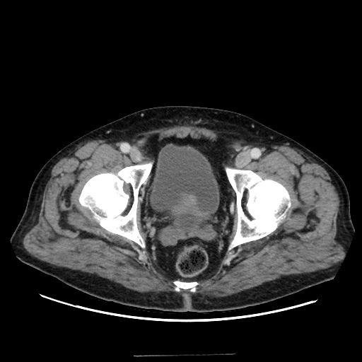 Choledocholiathiasis with normal caliber common bile duct (Radiopaedia 75368-86632 A 179).jpg
