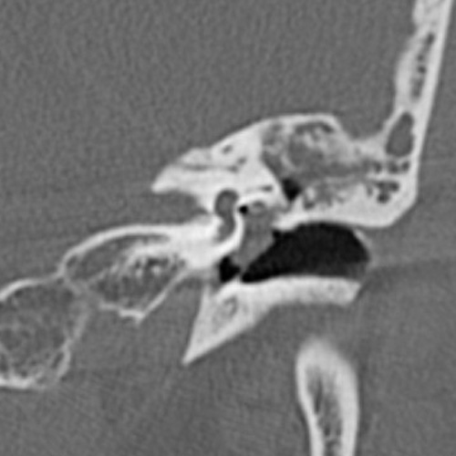 File:Cholesteatoma (Radiopaedia 9408-10093 Coronal bone window 6).jpg