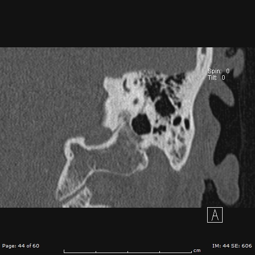 Cholesteatoma - external auditory canal (Radiopaedia 88452-105096 Coronal bone window 44).jpg