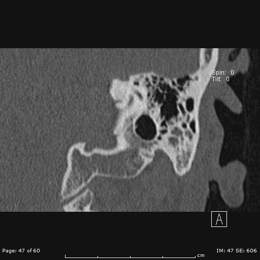 Cholesteatoma - external auditory canal (Radiopaedia 88452-105096 Coronal bone window 47).jpg