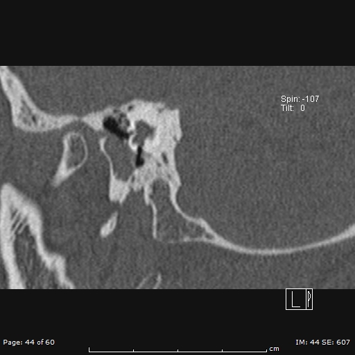 Cholesteatoma - external auditory canal (Radiopaedia 88452-105096 Sagittal bone window 44).jpg