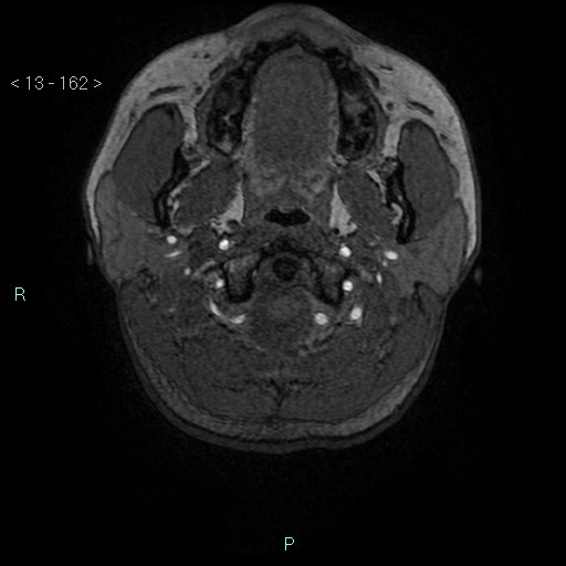 Cholesterol granuloma of the petrous apex (Radiopaedia 64358-73140 Axial TOF 3D 78).jpg