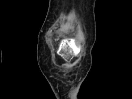 Chondrosarcoma - femur (Radiopaedia 64187-72954 C 9).jpg