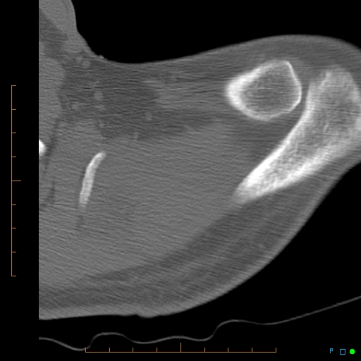 File:Chondrosarcoma of the scapula (Radiopaedia 30696-31399 Axial non-contrast 19).jpg