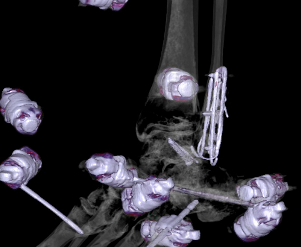 File:Chopart fracture (Radiopaedia 35347-36861 3D MPR bone window 6).jpg