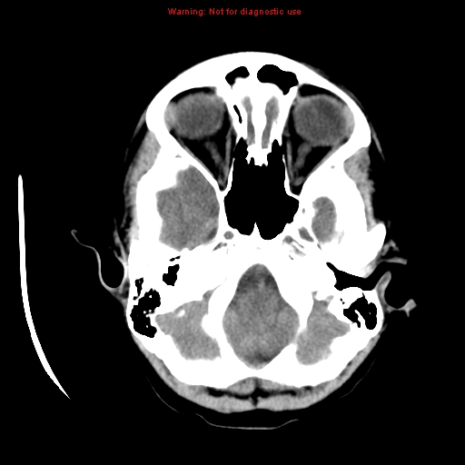 File:Choroid plexus carcinoma - recurrent (Radiopaedia 8330-9168 Axial non-contrast 4).jpg