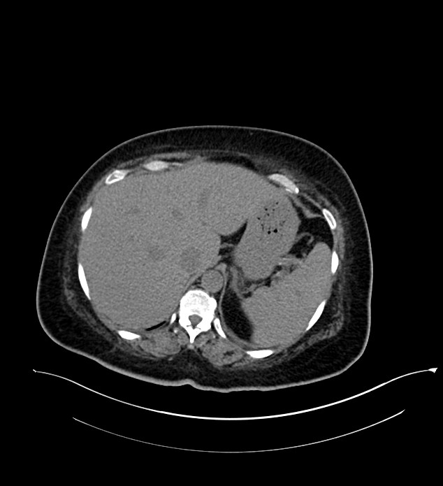 Chromophobe renal cell carcinoma (Radiopaedia 84239-99519 Axial non-contrast 40).jpg