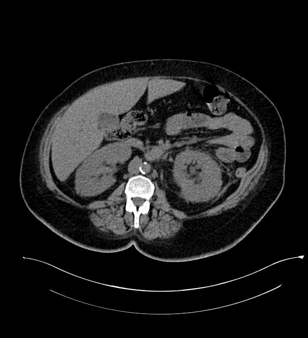 Chromophobe renal cell carcinoma (Radiopaedia 84239-99519 Axial non-contrast 79).jpg