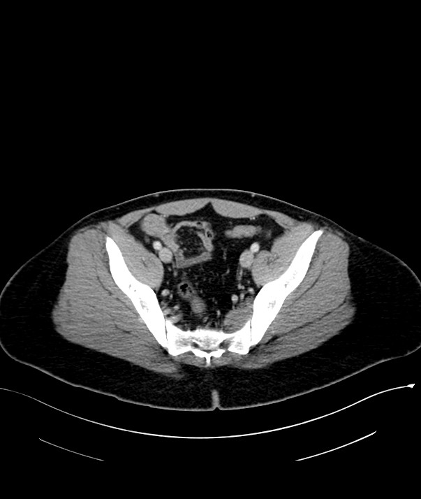 Chromophobe renal cell carcinoma (Radiopaedia 84255-99542 F 70).jpg