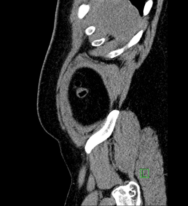 Chromophobe renal cell carcinoma (Radiopaedia 84286-99573 C 176).jpg
