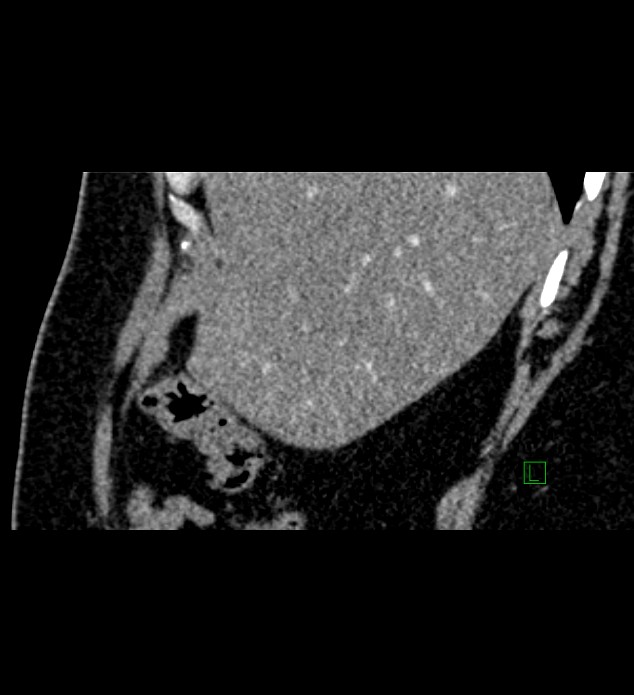 Chromophobe renal cell carcinoma (Radiopaedia 84286-99573 F 147).jpg