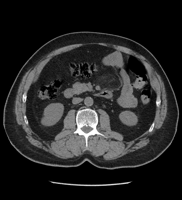 Chromophobe renal cell carcinoma (Radiopaedia 86879-103083 Axial non-contrast 46).jpg