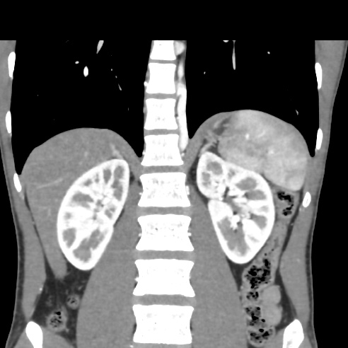 File:Chronic calcific pancreatitis (Radiopaedia 56280-62953 E 22).jpg