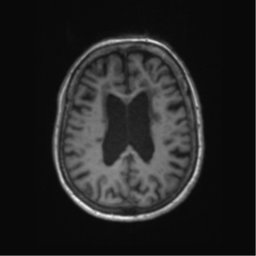 Chronic hypertensive encephalopathy (Radiopaedia 72844-83495 Axial T1 27).png