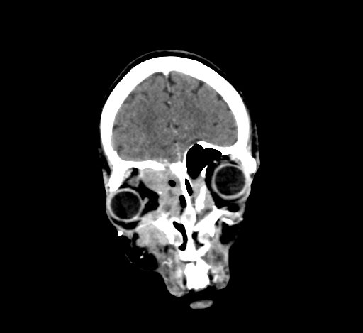 Chronic invasive fungal sinusitis with intraorbital and intracranial extension (Radiopaedia 56387-63046 C 74).jpg