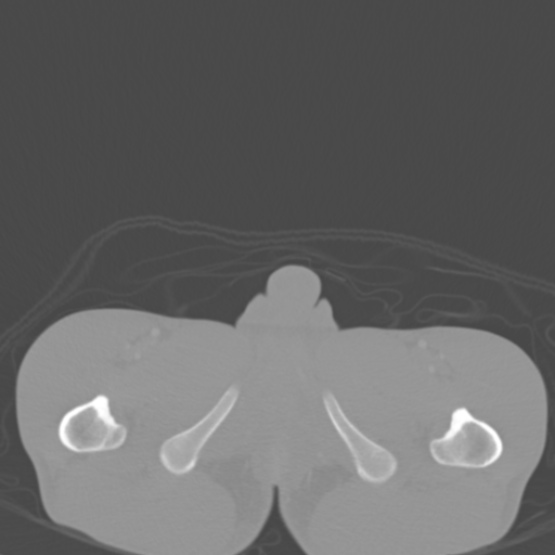 Chronic large bowel pseudo-obstruction (Radiopaedia 43181-46492 Axial bone window 172).jpg