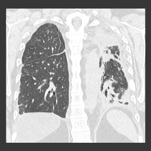 Chronic lung allograft dysfunction - restrictive form (Radiopaedia 60595-68316 Coronal lung window 71).jpg