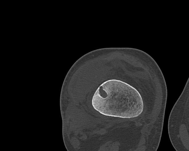 Chronic ostemyelitis of the femur with long sinus tract (Radiopaedia 74947-85982 Axial bone window 198).jpg